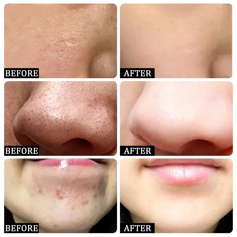 Salicylic Acid Pore Clearing C - Azelaic Acid Cream avis et prix