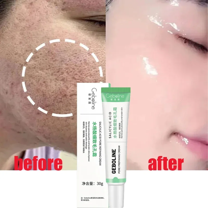 Salicylic Acid Pore Shrinking  - Azelaic Acid Cream avis et prix