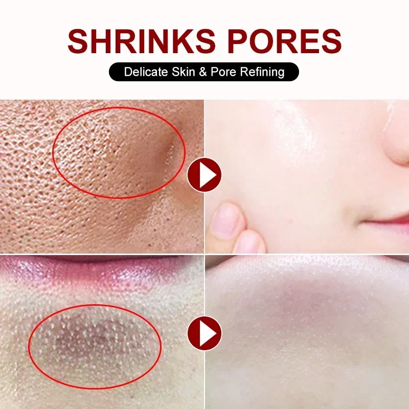 Salicylic Acid Pore Shrinking  - Azelaic Acid Cream avis et prix